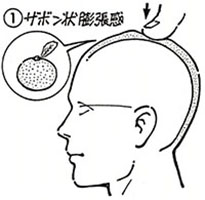 ①ザボン状膨張感