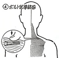④ボルト状厚結感